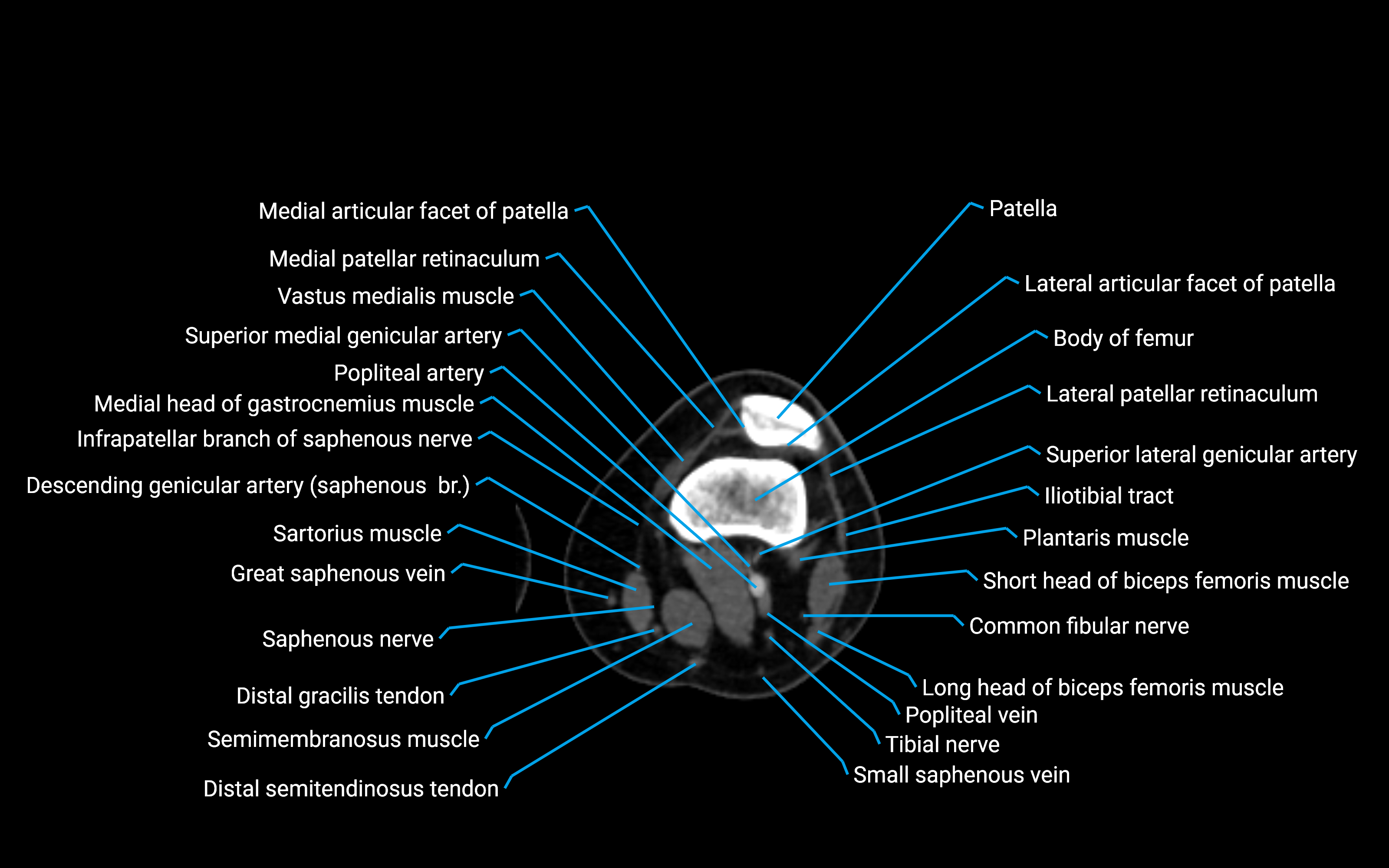 CT Lower leg axial cross sectional anatomy labelled image 81 (2).png